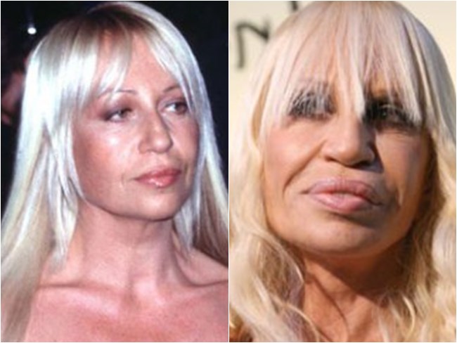 preenchimento boca donatella versace