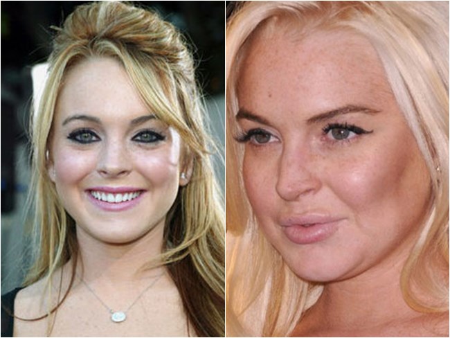 preenchimento boca lindsay lohan