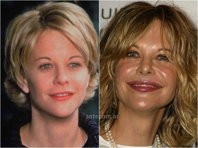 preenchimento boca meg ryan