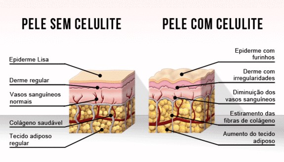 graus da celulite